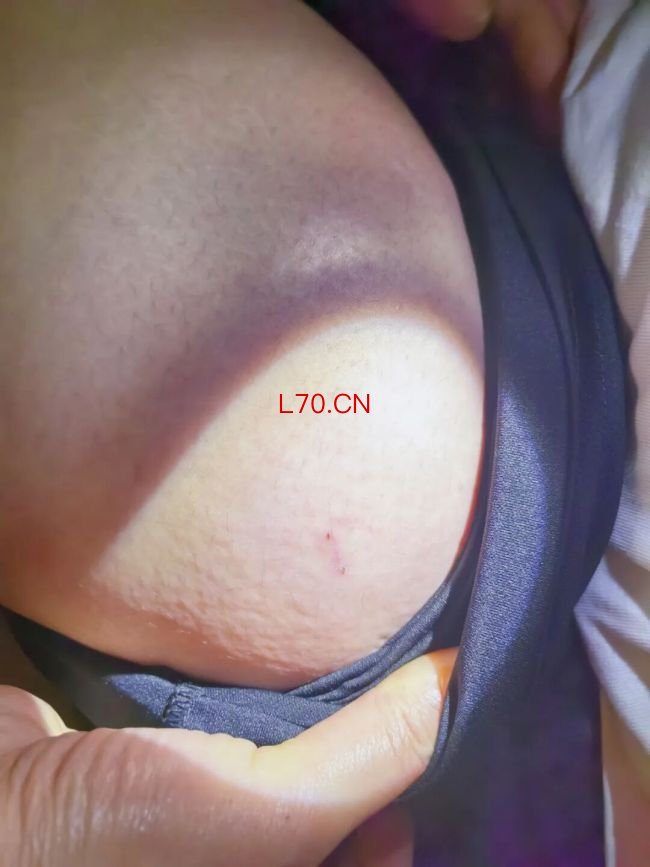 女生被蜈蚣咬伤患脑病